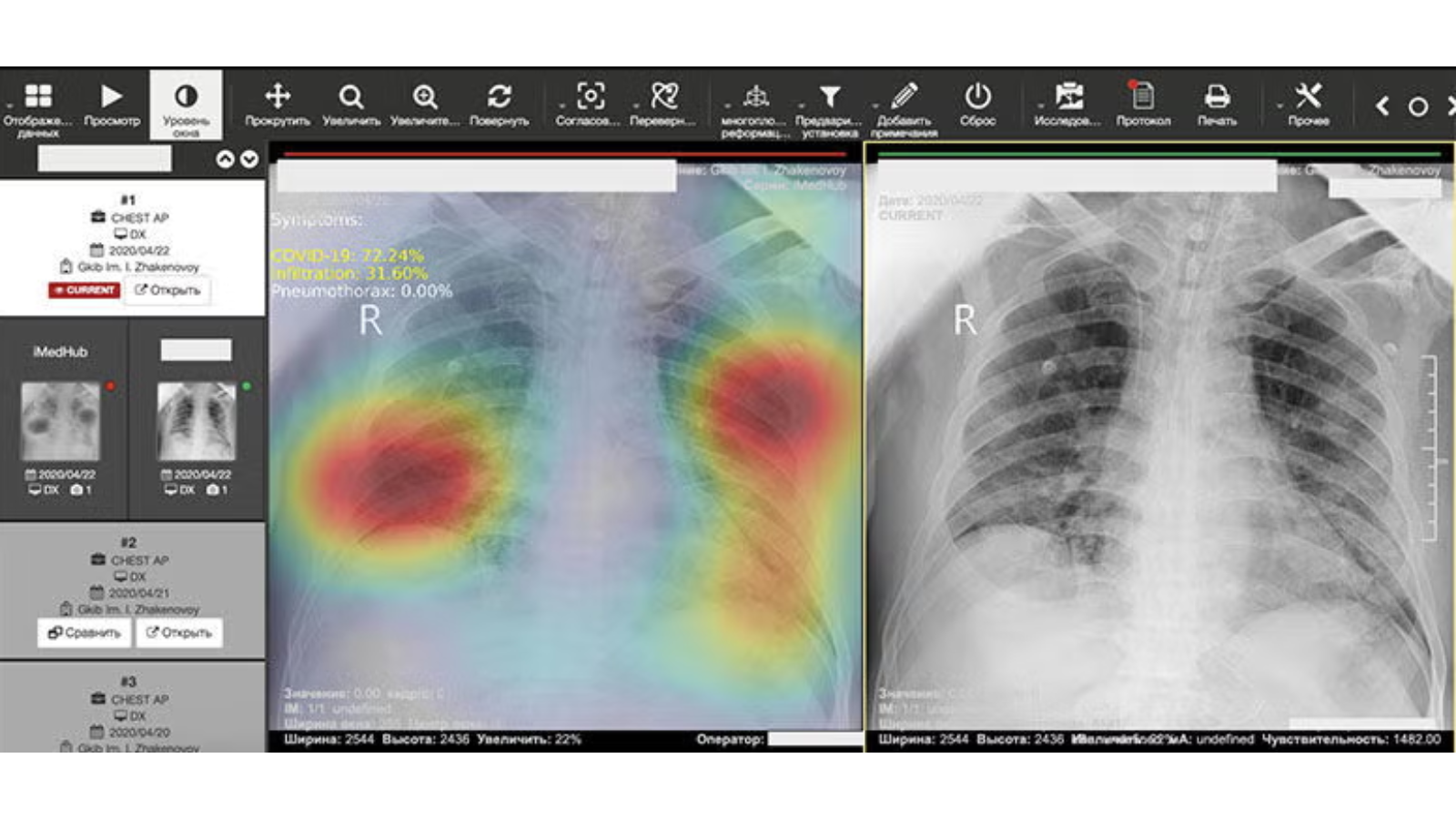 PneumoNet — система диагностики заболеваний легких на основе искусственного интеллекта